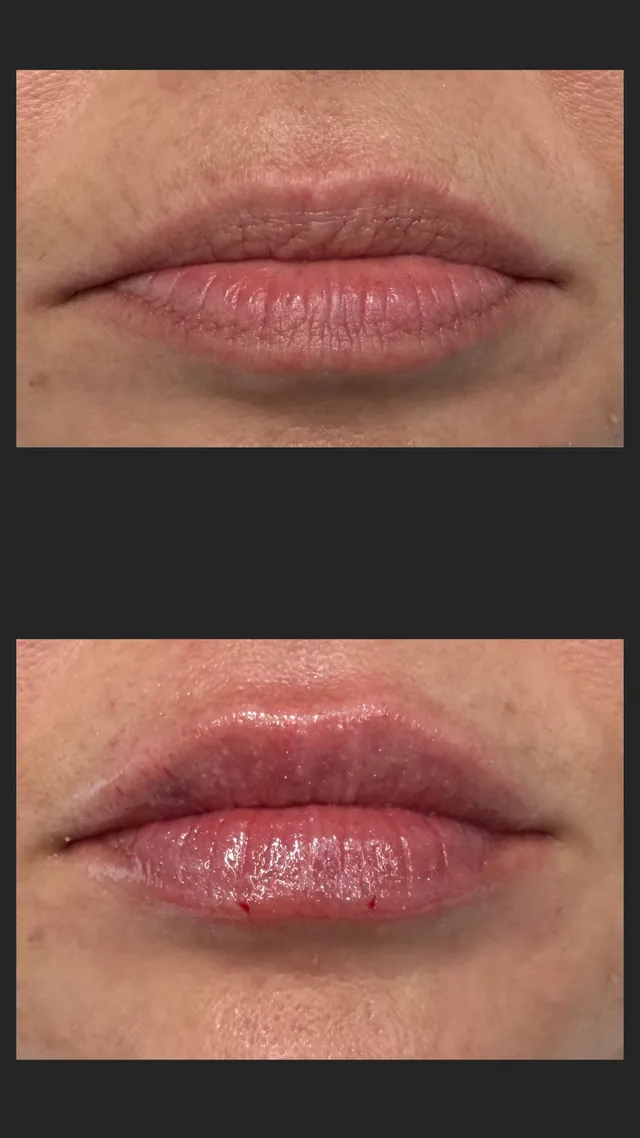 Hijaluronski fileri · Usne — prije i poslije tretmana