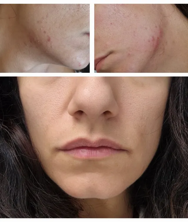Microneedling · PRP — prije i poslije tretmana