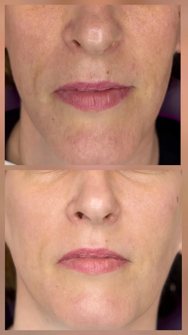 Skinbooster · Jalupro Super Hydro — prije i poslije tretmana