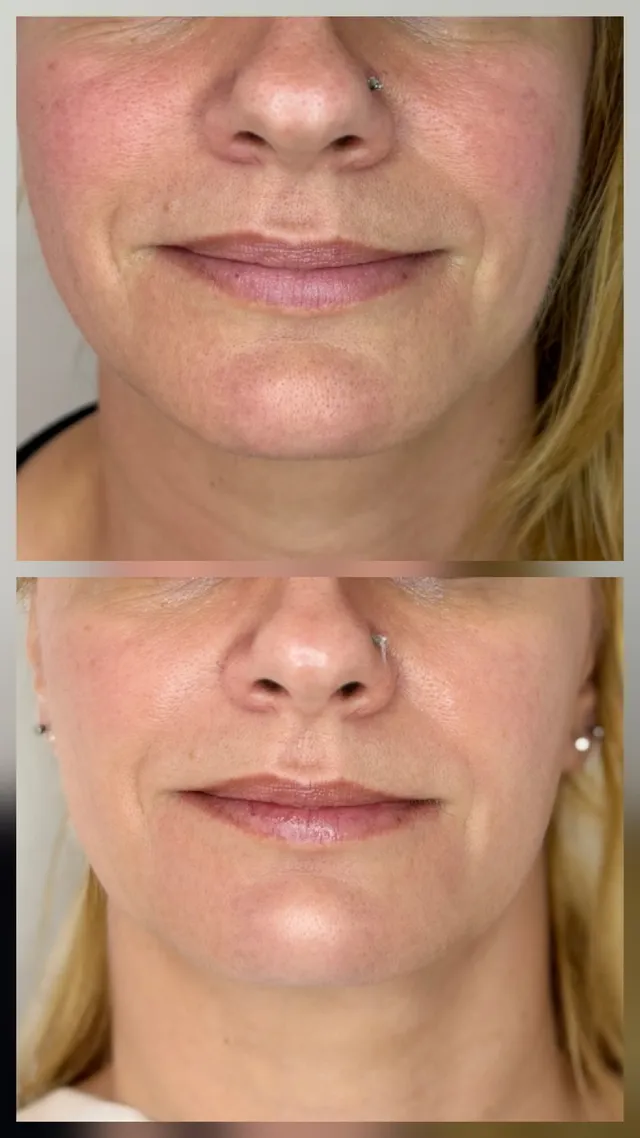 Skinbooster · Jalupro Super Hydro — prije i poslije tretmana